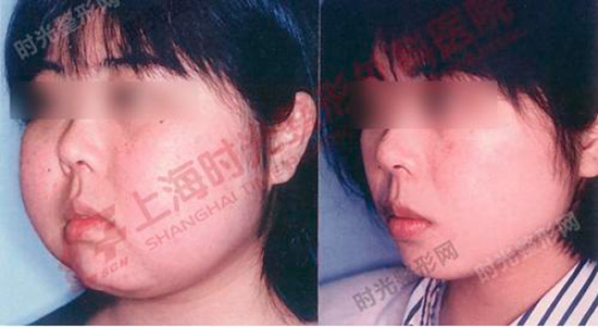 لاغر کردن دائمی صورت (درمان چاقی صورت)